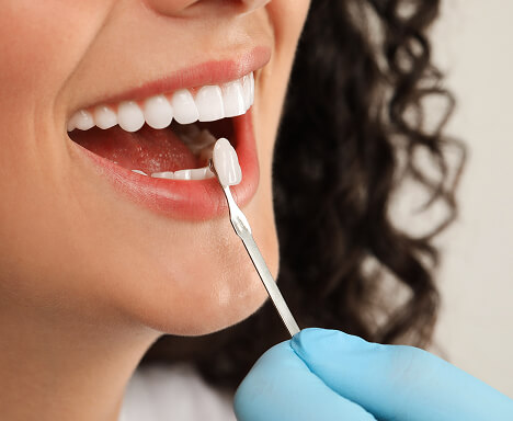 Dental Veneers